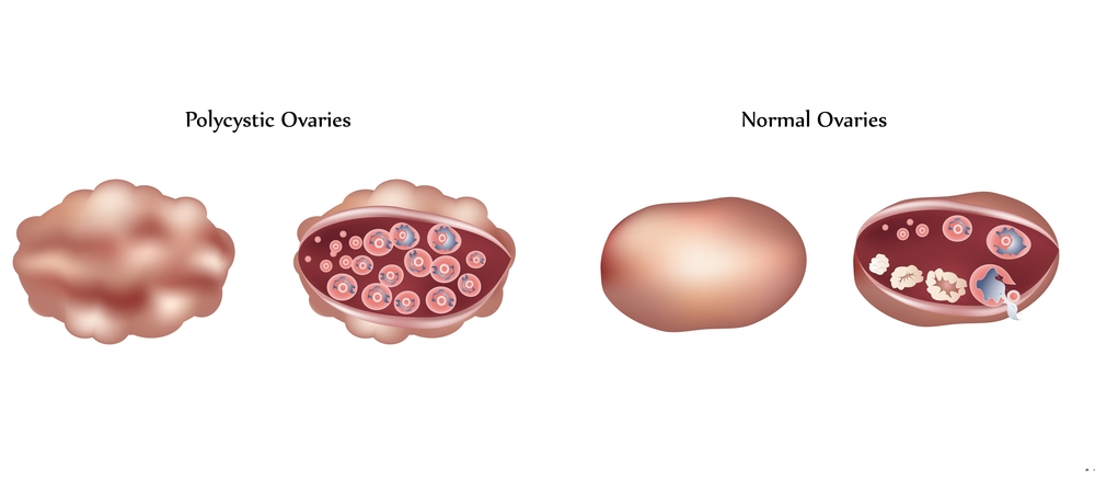 Πολυκυστικές ωοθήκες και Σύνδρομο πολυκυστικών ωοθηκών (PCOS)